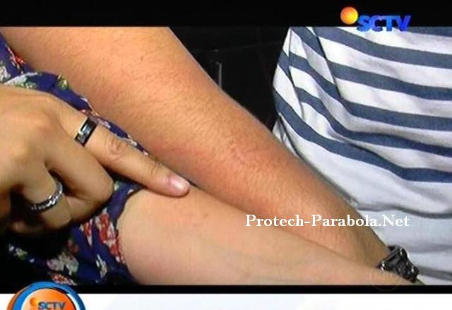 Gigitan pada Tangan Aliando dan Prilly